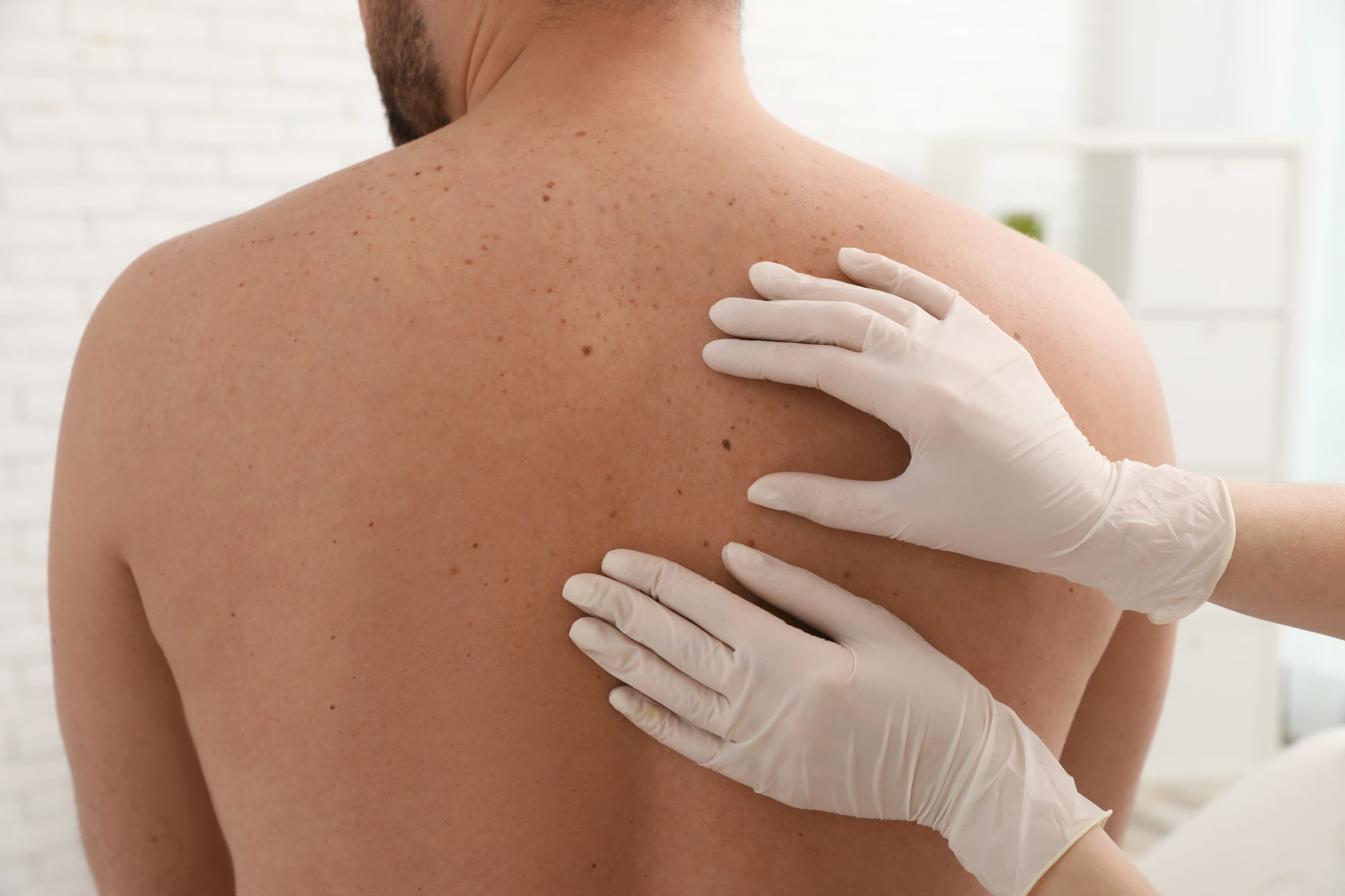 Skin Cancer Check Narangba at Narangba Station Health Centre