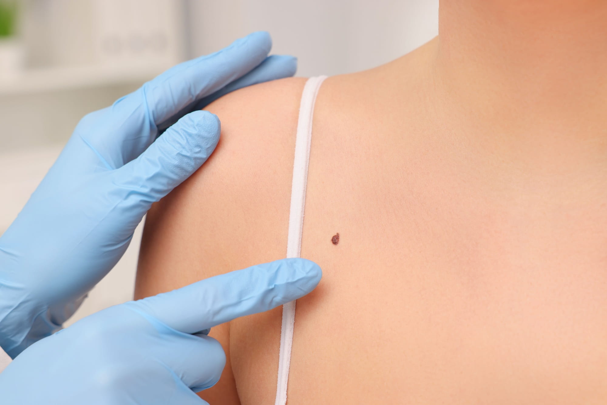 Who Should Get a Skin Cancer Check