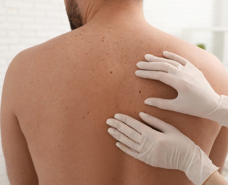 Skin Cancer Check